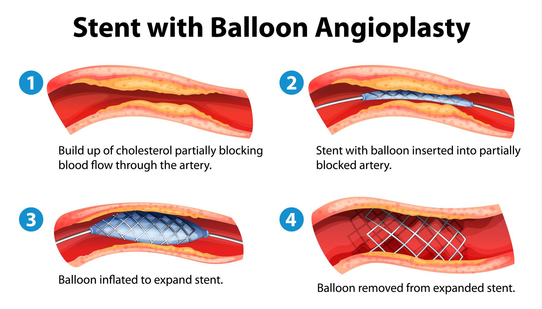 Balloon Angioplasty and Stent Placement Cardiovascular